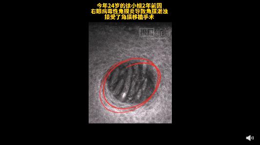 女孩睫毛長(zhǎng)58只螨蟲險(xiǎn)失明，預(yù)防眼部螨蟲感染要注意用眼衛(wèi)生